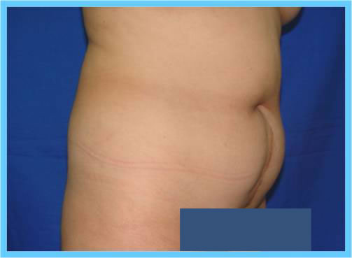 abdominoplasty